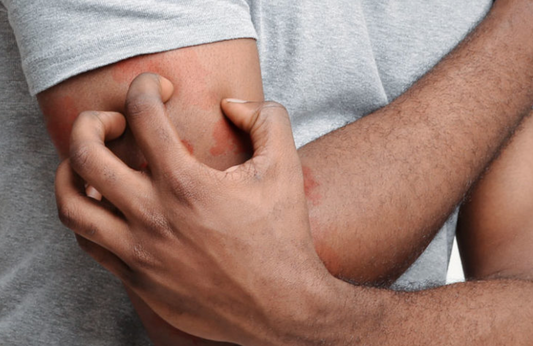 Why is my Eczema dry skin so itchy?
